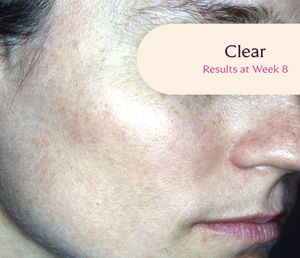 Female facial melasma before TRI-LUMA® cream melasma treatment