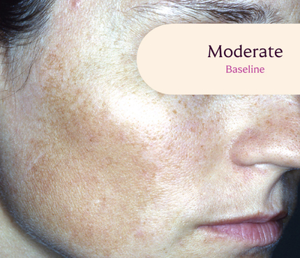 Female facial melasma before TRI-LUMA® cream melasma treatment