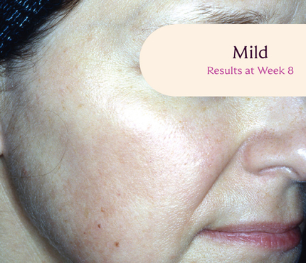 Female facial melasma before TRI-LUMA® cream melasma treatment