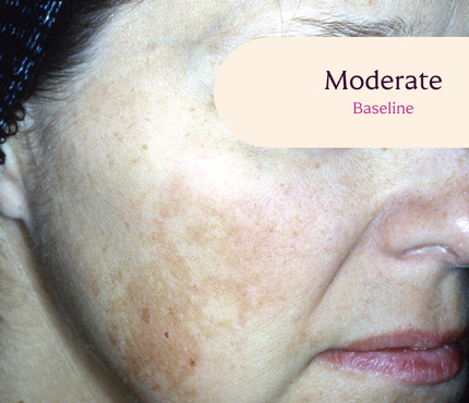 Female facial melasma before TRI-LUMA® cream melasma treatment