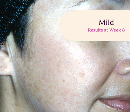 Female facial melasma before TRI-LUMA® cream melasma treatment