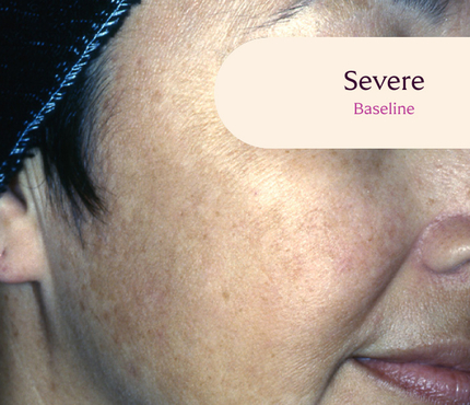 Female facial melasma before TRI-LUMA® cream melasma treatment