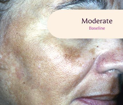 Female facial melasma before TRI-LUMA® cream melasma treatment