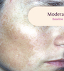 Female facial melasma before TRI-LUMA® cream melasma treatment