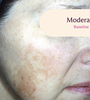 Female facial melasma before TRI-LUMA® cream melasma treatment