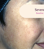 Female facial melasma before TRI-LUMA® cream melasma treatment