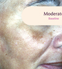 Female facial melasma before TRI-LUMA® cream melasma treatment